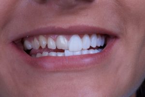 Dental-Veneer-1.jpg